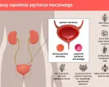 Ilustracja przedstawia objawy zapalenia pęcherza moczowego: ból, pieczenie, nietrzymanie moczu, gorączkę i mętny mocz.