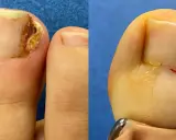 Avant/après chirurgie d'un ongle incarné douloureux par un podologue. Le pied gauche montre l'ongle abîmé, le droit, après intervention, suturé.