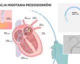 Ilustracja przedstawia zabieg ablacji migotania przedsionków, gdzie cewniki diagnostyczne i ablacyjne docierają do serca, by zlokalizować i zniszczyć źródło arytmii.