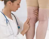 Lekarz bada nogi pacjentki, oceniając potencjalny stan zapalny i jego związek z d-dimerami.