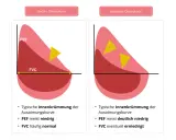 Diagramm zeigt Lungenfunktion bei Asthma. Links leichte Obstruktion mit PEF meist niedrig, rechts deutliche Obstruktion mit PEF deutlich niedrig.
