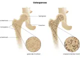 Vergleich gesunder und osteoporotischer Knochen. Rauchen kann Osteoporose fördern, indem es die Knochendichte verringert.