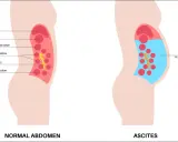 Ilustracja porównująca prawidłowy brzuch z brzuchem z wodobrzuszem (ascites), pokazująca nagromadzenie płynu.