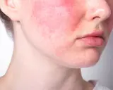 Guance arrossate e pelle irritata, possibili effetti dell'alcol sul viso.