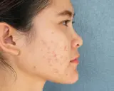 Profil d'une jeune femme avec des marques d'acné sur le visage. Des conseils sur comment enlever les cicatrices d'acné peuvent aider à retrouver une peau nette.