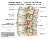 Detail der Lendenwirbelsäulen-L4-L5-Region mit Bandscheibenvorfall, der eine Nervenwurzel komprimiert. Anatomie der Lende.