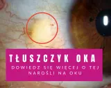 Widoczna biała plamka na białku oka, otoczona czerwonym okręgiem, to tłuszczyk. Dowiedz się więcej o tej narośli.