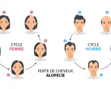 Illustration du cycle de la perte de cheveux, montrant l'alopécie chez la femme et l'homme.