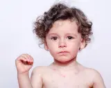 Bambino con puntini rossi sul corpo e viso, possibili puntini rossi eritema solare bambini.