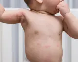 Un bébé a des rougeurs et des petits boutons sur le corps, notamment sur le torse et les bras.