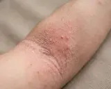 Bras atteint de dermatite atopique, avec peau rouge, sèche et squameuse, quelques petites vésicules.