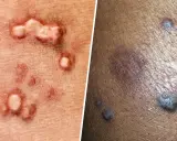 Primer plano de verrugas negras genitales y otras lesiones cutáneas.