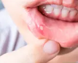 En person pekar på ett sår i munnen, troligen ett virus i munnen.
