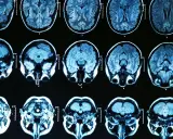 Przekroje mózgu na rezonansie magnetycznym. Badanie może pomóc w diagnostyce choroba parkinsona przyczyny.