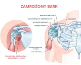 Anatomia barku z zaznaczonym mięśniem dwugłowym ramienia i pogrubioną torebką stawu, ilustracja problemu "zamrożonego barku".