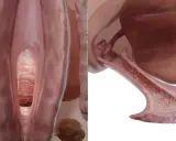 Vista 3D del canal vaginal con aspecto blanquecino y rugoso, indicativo de síntomas de candidiasis vaginal.