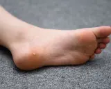 Piede con una piccola verruca inizio sul tallone, su sfondo grigio.