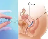 Anillo vaginal anticonceptivo en mano y su ubicación en el útero. No se debe quitar el anillo anticonceptivo durante relaciones.