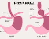 Hernia de hiato: Identifica sus síntomas y cuándo buscar ayuda.