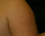 Éruption cutanée sur le bras, possiblement du pityriasis alba. Le traitement est souvent simple et vise à hydrater la peau.