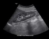 Obraz USG nerki. Czy usg jamy brzusznej wykryje raka? Badanie pokazuje strukturę nerki, pomagając w diagnostyce.
