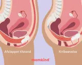 Illustration visar bäckenbottenmuskulaturen i avslappnat och kontraherat läge. Knipövningar är en del av symfysit behandling.