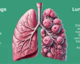 Vergleich von gesunder Lunge und Lunge mit COPD. Die COPD-Lunge zeigt geschädigte Lungenbläschen und verdickte Bronchien, was zu Atemnot führt, auch ohne Husten.