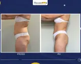 Liposukcja: Modelowanie sylwetki czy odchudzanie? Poznaj prawdę