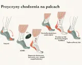 Ilustracja pokazuje, dlaczego dziecko chodzi na palcach: autyzm, ADHD, dystrofia mięśniowa, przykurcz ścięgna Achillesa, nadwrażliwość dotykowa.