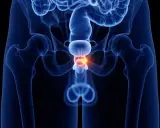 Anatomical illustration of male pelvic organs, highlighting the prostate with a red glow, suggesting inflammation. To understand czemu po alkoholu boli prostata, this image shows the affected area.
