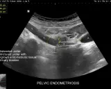 USG miednicy: poszerzony i zwężony moczowód z tkanką endometrialną, pęcherz moczowy.