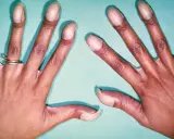 Hände mit trommelschlegelfinger-ähnlichen Fingerkuppen, die auf eine mögliche Erkrankung hindeuten.