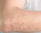 Skóra ramienia z licznymi zaczerwienionymi, swędzącymi zmianami, które mogą być objawami nietolerancji histaminy.