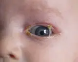Occhio di bambino con secrezioni giallastre, sintomo di congiuntivite.