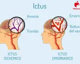 Ictus: confronto tra ischemico (trombo) ed emorragico (rottura vaso). L'emorragia cerebrale negli anziani è un rischio.
