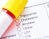 Esame del sangue con provetta e modulo di analisi. La casella "Amylase" è spuntata, indicando un controllo dei valori normali di amilasi.