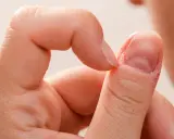 Zbliżenie na palec z widocznymi oznakami chorób paznokci, takich jak łuszczenie się skóry wokół paznokcia i jego nierówna powierzchnia.