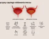 Ilustracja pokazuje pusty i pełny pęcherz moczowy, wyjaśniając przyczyny częstego oddawania moczu, w tym uczucie pełnego pęcherza.