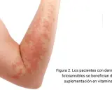 Brazo con erupción cutánea roja y escamosa.