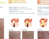Schéma illustrant les différents types d'acné, des points blancs aux kystes, montrant l'évolution d'un bouton de puberté.