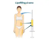 Illustrazione del lipofilling al seno: grasso prelevato da addome e cosce viene iniettato per aumentare il volume del seno.