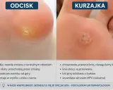 Porównanie kurzajki i odcisku na stopie. Kurzajka jest chropowata i wywołana wirusem HPV, a odcisk gładki i powstaje od ucisku.