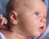 Nahaufnahme eines Babys mit roten Pickelchen im Gesicht. Die Frage "Babyakne wie lange" beschäftigt viele Eltern.