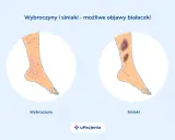 Wybroczyny i siniaki na nogach mogą być objawami białaczki szpikowej. Ilustracja pokazuje zmiany skórne.