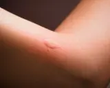 Gros plan sur un bras humain montrant une réaction cutanée rouge et enflée, typique d'une allergie ou d'un bouton de moustique.