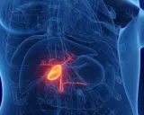 Anatomical rendering of a human torso showing the gallbladder highlighted in yellow and red, indicating potential rak pęcherzyka żółciowego.