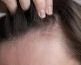 Une main soulève des mèches de cheveux, révélant des pellicules sur le cuir chevelu. Une pellicule enfant peut être une préoccupation pour les parents.