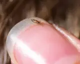 Un pidocchio, pronto per il trattamento, si muove su un'unghia.