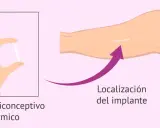 Mano sostiene implante anticonceptivo subdérmico. Flecha indica localización del implante en el brazo.