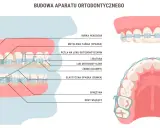 Ile nosi się aparat stały? Czas leczenia i jak go skrócić